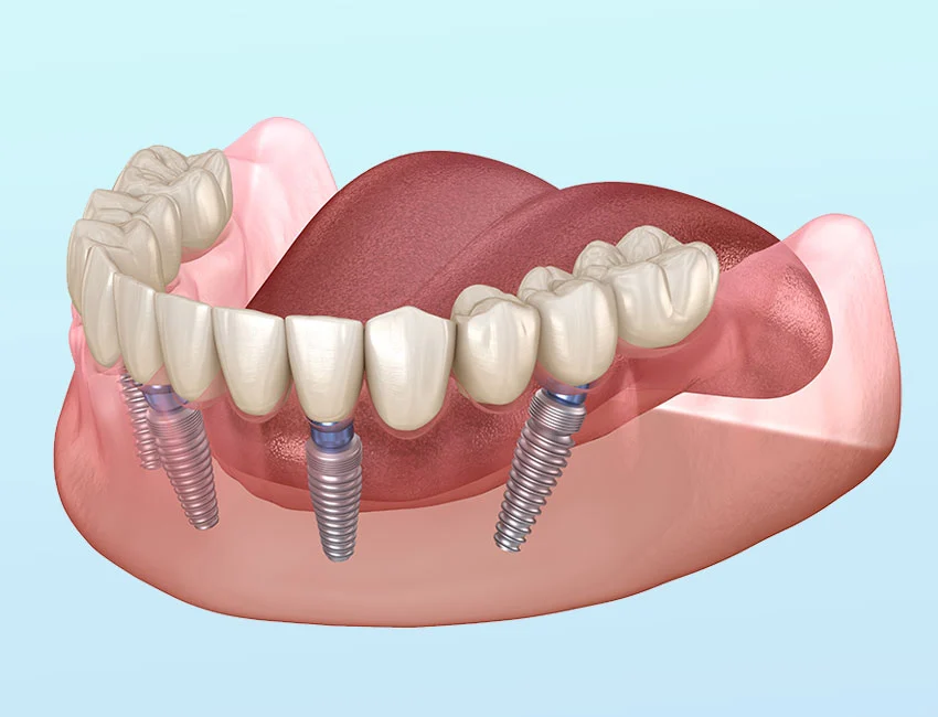 All-on-4 dental implants