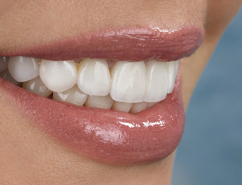 Beautiful smile with veneers